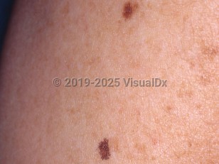 Clinical image of Lentigo simplex - imageId=3435273. Click to open in gallery.  caption: 'A close-up of two well-demarcated brown macules.'