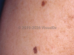 Clinical image of Lentigo simplex - imageId=3435273. Click to open in gallery.  caption: 'A close-up of two well-demarcated brown macules.'