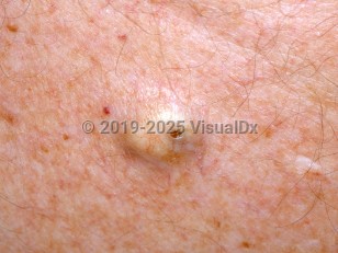 Clinical image of Epidermoid cyst - imageId=3463753. Click to open in gallery.  caption: 'A close-up of a yellowish nodule with a central keratin-filled punctum.'