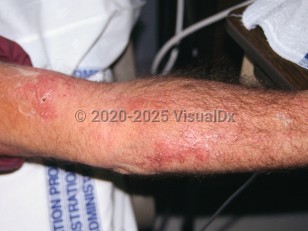 Clinical image of Protothecosis - imageId=3529643. Click to open in gallery.  caption: 'Crusted, erythematous papules and plaques on the arm.'