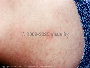 Clinical image of Centipede envenomation - imageId=3590859. Click to open in gallery.  caption: 'Erythematous papules and thin plaques, some linear in configuration, on the flank.'