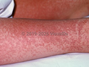 Drug-induced hypersensitivity syndrome