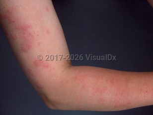 Clinical image of Urticaria - imageId=376064. Click to open in gallery.  caption: 'Edematous pink papules and plaques on the arm.'