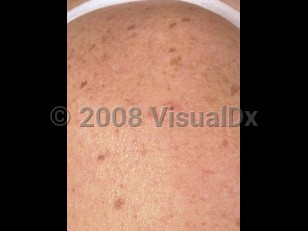 Clinical image of Familial leiomyomatosis cutis et uteri - imageId=3789056. Click to open in gallery.  caption: 'Faint pink papules on the shoulder (leiomyomas). Note the unrelated lentigines secondary to sun damage.'