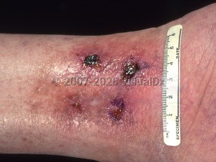 Clinical image of Ischemic ulcer - imageId=380209. Click to open in gallery.  caption: 'Erosions and ulcers, some crusted and one with an overlying eschar, at the ankle.'