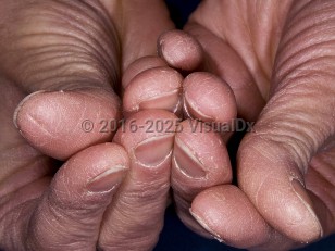 Clinical image of Irritant contact dermatitis - imageId=3921662. Click to open in gallery.  caption: 'Dry skin and scaling of the fingertips.'