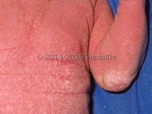 Clinical image of KID syndrome - imageId=39433. Click to open in gallery.  caption: 'Diffuse scaling and hyperkeratosis and background erythema on the trunk and arm.'