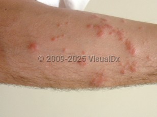 Clinical image of Sea anemone sting - imageId=3971527. Click to open in gallery.  caption: 'Numerous erythematous and markedly edematous papules, some in linear arrays, on the forearm.'