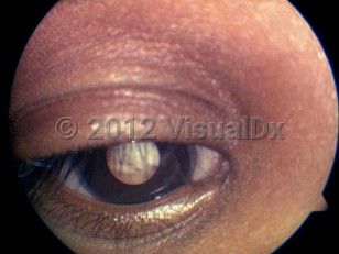 Ophthalmic Imaging image of Retinoblastoma - imageId=4176090. Click to open in gallery.  caption: 'Leukocoria.'