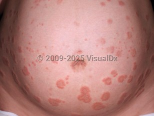Clinical image of Pemphigoid gestationis - imageId=4240981. Click to open in gallery.  caption: 'Urticarial and targetoid papules and plaques on a pregnant belly.'