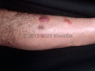 Clinical image of Mycobacterium chelonae infection - imageId=4262364. Click to open in gallery.  caption: 'Erythematous nodules, one crusted and with overlying scale, on the leg of a renal transplant patient.'