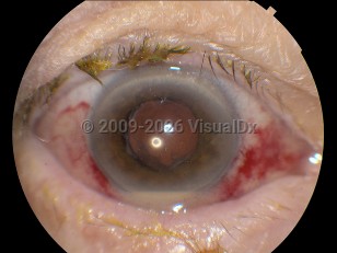 Ophthalmic Imaging image of Endophthalmitis - imageId=4379327. Click to open in gallery. 