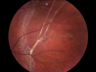 Ophthalmic Imaging image of Retinal detachment - imageId=4381439. Click to open in gallery. 