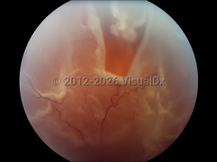 Ophthalmic Imaging image of Retinal tear - imageId=4382977. Click to open in gallery. 