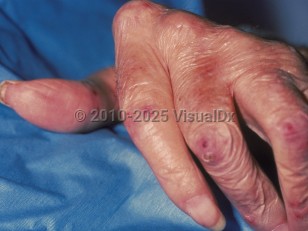 Clinical image of Rheumatoid vasculitis - imageId=44401. Click to open in gallery.  caption: 'Purpuric papules and crusting with surrounding pink erythema on the thumb and fingers.'