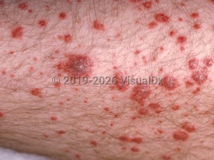 Immunoglobulin A vasculitis