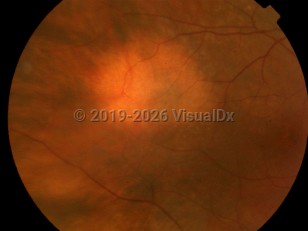Ophthalmic Imaging image of Choroidal nevus - imageId=4537664. Click to open in gallery.  caption: 'An amelanotic choroidal nevus, appearing as a hypopigmented patch.'