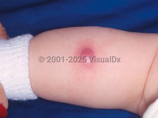 Clinical image of Chronic granulomatous disease - imageId=459553. Click to open in gallery.  caption: 'A deep pink nodule with surrounding erythema on the leg.'