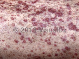 Clinical image of Multiple myeloma - imageId=4607088. Click to open in gallery.  caption: 'A close-up of multiple violaceous macules and papules.'