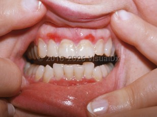 Clinical image of Desquamative gingivitis - imageId=4762688. Click to open in gallery.  caption: 'Erosions along the upper and lower gingival margins.'