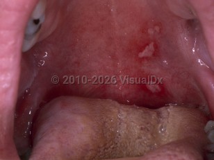 Clinical image of Herpangina - imageId=4772543. Click to open in gallery.  caption: 'Slough-covered erosions on the left palate.'