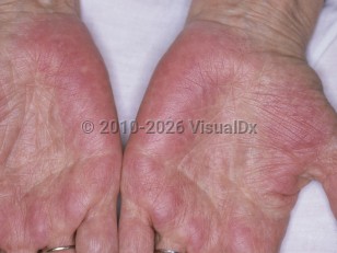 Clinical image of Palmar erythema - imageId=4791799. Click to open in gallery.  caption: 'Widespread red and violaceous patches on the palms.'