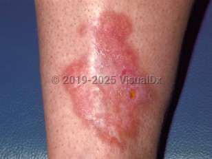 Clinical image of Necrobiosis lipoidica - imageId=48123. Click to open in gallery.  caption: 'An erythematous, shiny plaque with central scarring and erosion on the shin.'