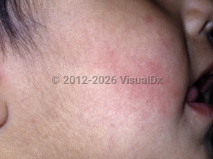 Clinical image of Auriculotemporal syndrome - imageId=4815673. Click to open in gallery.  caption: 'Flushing of the cheek.'