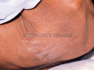 HIV/AIDS-related pruritus