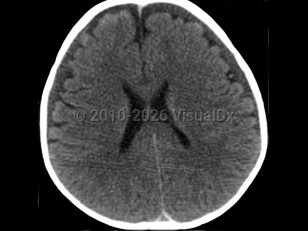 Imaging Studies image of Pediatric abusive head trauma - imageId=4989248. Click to open in gallery.  caption: '<span>Noncontrast head CT demonstrates bilateral chronic subdural hematomas. Note the difference in densities between CSF (in the ventricles) and the fluid in the subdural space. The subdural fluid is more dense and may consist of old blood or blood mixed with CSF.</span>'