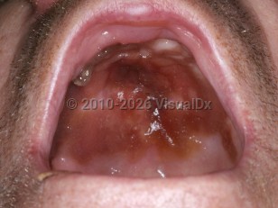Clinical image of Extranodal NK/T-cell lymphoma, nasal type - imageId=5073152. Click to open in gallery.  caption: 'Ulceration and crusting on the palate.'