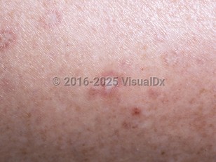 Clinical image of Malignant atrophic papulosis - imageId=5073217. Click to open in gallery.  caption: 'A close-up of porcelain-white, depressed papules with reddish rims.'