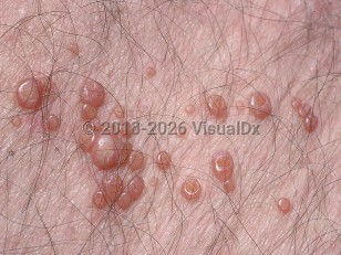 Clinical image of Molluscum contagiosum - imageId=514304. Click to open in gallery.  caption: 'A close-up of a cluster of umbilicated pink papules.'