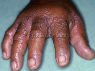 Scombroid fish poisoning