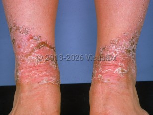 Clinical image of Acquired acrodermatitis enteropathica - imageId=524508. Click to open in gallery.  caption: 'Fairly well-demarcated eroded, crusted, and scaly plaques on the lower legs.'