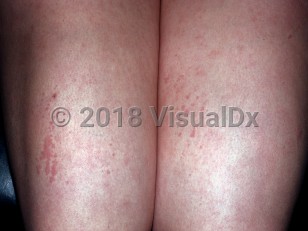 Clinical image of Adult-onset Still disease - imageId=5257434. Click to open in gallery.  caption: 'Linear arrays of urticarial papules on the legs.'