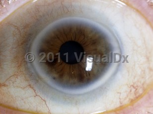 Ophthalmic Imaging image of Arcus senilis - imageId=5329507. Click to open in gallery.  caption: 'Thick, white peripheral corneal ring.'