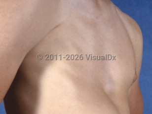 Clinical image of Poland syndrome - imageId=5361728. Click to open in gallery.  caption: 'Absence of the pectoral muscles and nipple-areola complex on the right chest.'