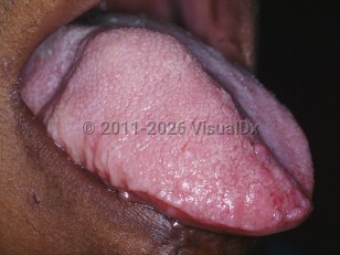 Clinical image of Hemihyperplasia - imageId=5362688. Click to open in gallery.  caption: 'Hyperplasia of the right side of the tongue.'
