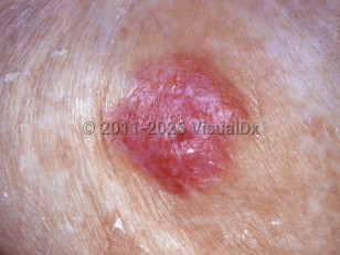 Clinical image of Paget disease of breast - imageId=5381923. Click to open in gallery.  caption: 'A macerated, eroded, and crusted plaque over the nipple and areola.'