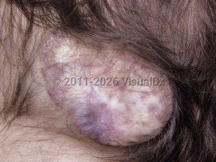Clinical image of Meningocele - imageId=5405916. Click to open in gallery.  caption: 'An exophytic yellowish-white and violaceous mass on the occipital scalp.'