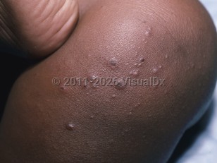 Echovirus infection