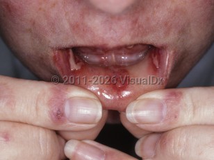 Clinical image of Pyostomatitis vegetans - imageId=5599600. Click to open in gallery.  caption: 'Large oral erosions, periungual erythema, and patchy erythema on the face.'