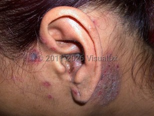 Kikuchi-Fujimoto disease