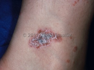 Clinical image of Tattoo reaction - imageId=5633827. Click to open in gallery. 