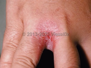Clinical image of Candidiasis - imageId=56576. Click to open in gallery.  caption: 'Erosio interdigitalis blastomycetica showing a macerated and eroded plaque at the finger web.'