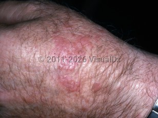 Actinic granuloma