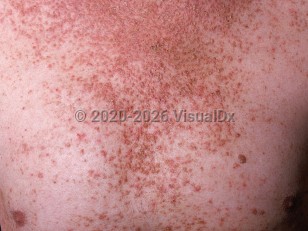 Darier disease