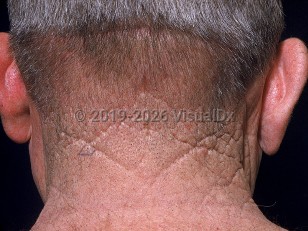 Clinical image of Cutis rhomboidalis nuchae - imageId=570677. Click to open in gallery.  caption: 'A thickened and leathery quality to the skin of the posterior neck, with an intersecting pattern of accentuated skin lines forming multiple quadrangular or rhomboidal shapes.'