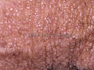 Clinical image of Colloid milium - imageId=5766196. Click to open in gallery.  caption: 'A close-up of myriad tiny pink and whitish papules.'